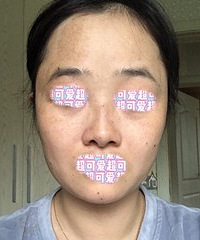 实拍记录我的激光祛斑过程,雀斑花了8000,送了一次免费祛痣
