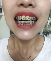 戴牙套快三个月了,边矫正边记录