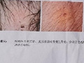 小孩子身上竟有针眼