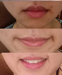 有没有什么解决嘴角纹的办法