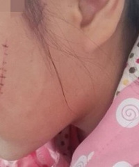 气死了,女儿在幼儿园脸被小朋友掐烂,老师居然不知道,这么多疤