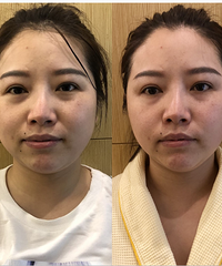 舒适的小颜术和抗糖冻龄术,让你轻松变小脸变好皮肤