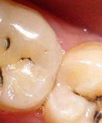 一个资深“烂牙”患者的忠告:看牙要趁早,不然你就会像我这样…
