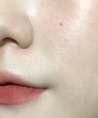 都来说说你觉得真正有用的医美项目吧!我提名水光针