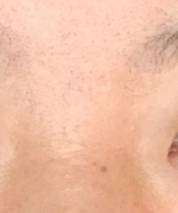 一单一双只做一只的双眼皮,发帖分享更新