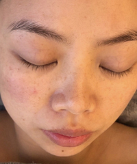 吐血安利这个项目!做完当场泛红就好了,换季敏感肌千万不要错过