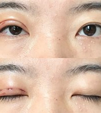 惊喜!现在双眼皮都能单只做了,我一单一双的大小眼终于有救了