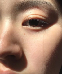 经历过全脸爆痘,现在我的脸终于可以见人了!分享我的祛痘心得
