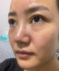 做了三次堪比热玛吉的fotona4d,感觉不用去做眼袋手术了