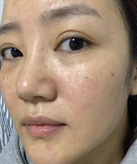 找到比热玛吉更好的抗衰神器,我一共做了3次,眼袋都快消失了