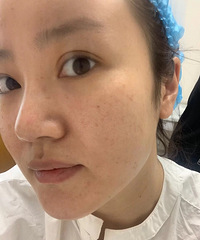 找到比热玛吉更好的抗衰神器,我一共做了3次,眼袋都快消失了