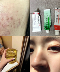 从全脸爆痘到稳定好肌肤,我做了这些