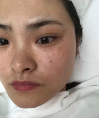 干敏皮做了M22光子嫩肤祛斑三次,分享下喜悦
