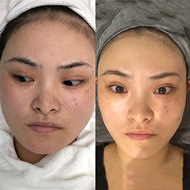 祛斑3天后,变化好大