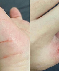 被宠物店的小猫抓伤,已经破皮,需要打破伤风或者狂犬疫苗吗