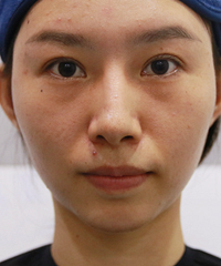 不愧是抗衰界的扛把子,它去法令纹也太牛了,不信来看我的效果