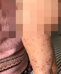 14个月的宝宝感染了手足口,还接种了疫苗+【护理日记】
