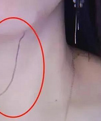 做完线雕2天后她随手揪出蛋白线!针对埋线问题专家给出13个答