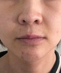 可怕!做完线雕2天后,她随手从脸上揪出了蛋白线……