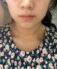记录打瘦脸针半年的变化,脸小一圈,别人以为我瘦了10斤