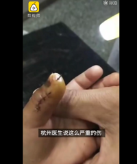幼师摔打3岁幼童造成孩子手指骨折,对家长撒谎说是被门夹的