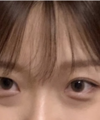 终于去掉先天性眼袋,7天就恢复完全,再也不会被人说没精神了