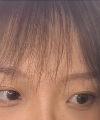 终于去掉先天性眼袋,7天就恢复完全,再也不会被人说没精神了