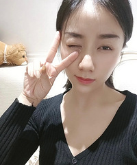 没做热门的鼻综合隆鼻,效果一样很满意