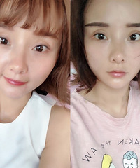 美颜10级都救不了的失败双眼皮,终于修复好了