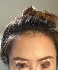秃头少女终于开始了漫长的植发之路