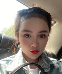 “秃头少女”终于开始了漫长的植发之路,6天头发就长出来了