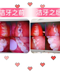 在这不到50元洁牙,还有专业的口腔检查,我给家里人都安排上了