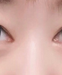 我去切眼袋了,你们不要再说我没睡醒了