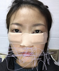 10分钟搞定的内切眼袋手术,发帖记录一下
