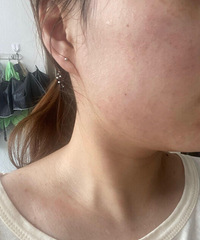 终于找到祛痘的好方法,3个月恢复好肌肤