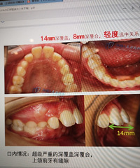 定期牙齿检查,不想来的口呼吸影响还是要逃不过了+护理日记