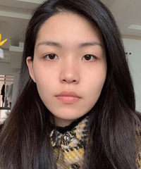 全切双眼皮开眼角,一整套一次性到位