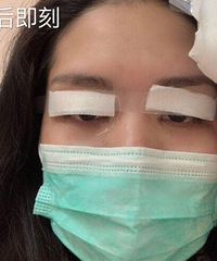 全切双眼皮开眼角,一整套一次性到位