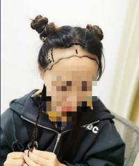 回顾帖:秃头小宝贝终于决定去植发啦