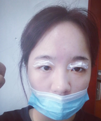 没想到做了双眼皮,不仅变漂亮了还瘦了20斤!来看4个月效果