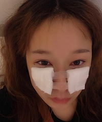 终于去做了眼袋框隔释放手术,姐妹们觉得效果如何