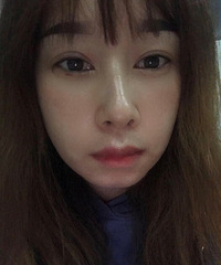 30几岁终于消灭掉我的大眼袋,一个月就恢复正常,拍照都好看多了