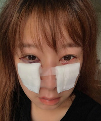 终于做了祛眼袋手术,我个人觉得不是很痛
