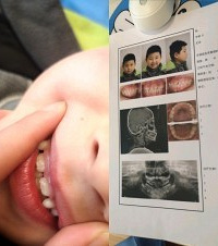 儿子的牙齿都定期检查,因为鼻炎还是变成了龅牙腔,下颌开始后缩