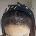 5个月成功长出发际线