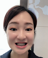 记录牙齿矫正的300天,我变得越来越爱笑了