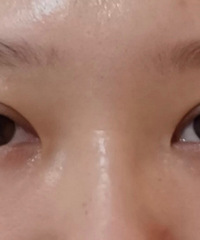 千万不要去小机构做双眼皮,我花4个月重新修复