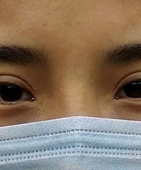 双眼皮修复半年后反馈,终于没有惹人烦的肉条感了!