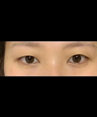 ˫��Ƥ�����£���ڲ���äĿѡ��̫����˫��Ƥ