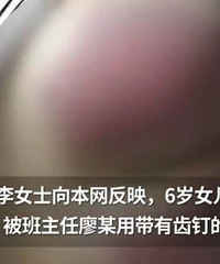 6岁儿童因未完成作业被老师殴打住院